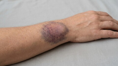 subcutaneous hematoma